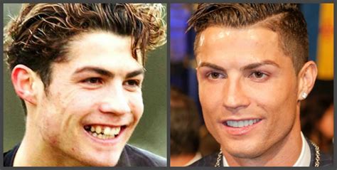 Cristiano Ronaldo - denti prima e dopo, una selezione di foto