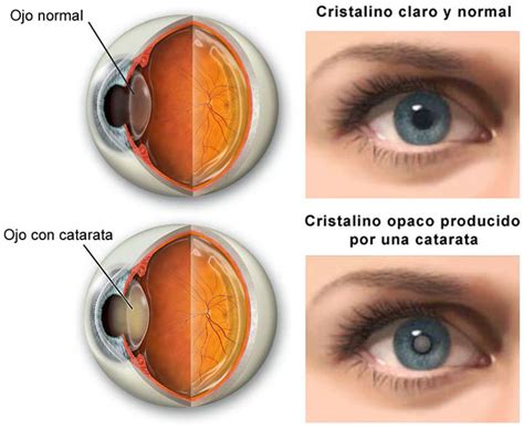 ¿Qué hacer si recientemente me han diagnosticado cataratas? - AVER