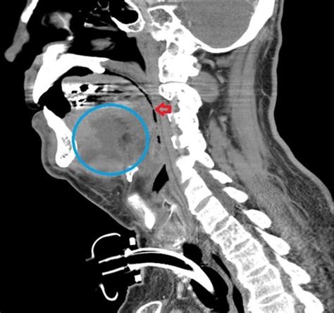 Ludwigs Angina Radiology