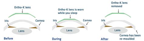 Orthokeratology | Optometrist Cherrybrook Eye Doctor Sydney Orthokeratology