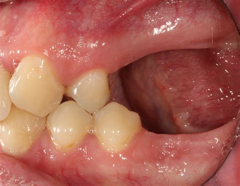 Bone grafting after tooth removal: Why, when, and what to use | Perio-Implant Advisory