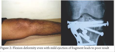 Tibia eminence fracture Archives - Trauma International