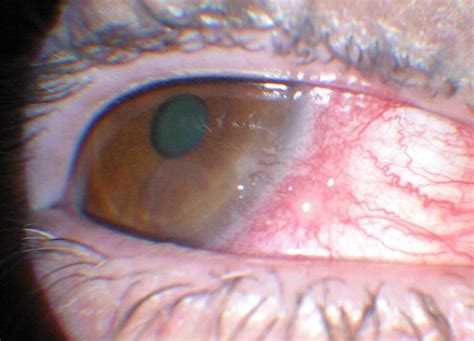 Phlyctenules and Phacomorphic Glaucoma