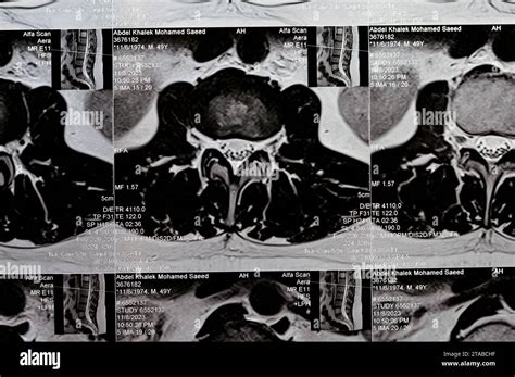 Cairo, Egypt, November 14 2023: MRI of lumbosacral spine revealed L3-L4, L4-L5 posterior disc ...