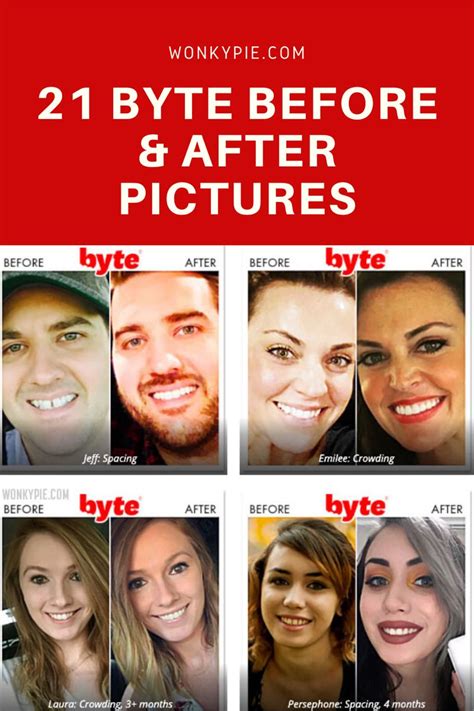 Byte Aligners: 21 Before & After Photos (Pics of Real Results!) | Teeth health, Teeth ...