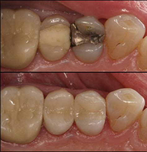 Composite Fillings - Dental Treatment | The Dental Surgery