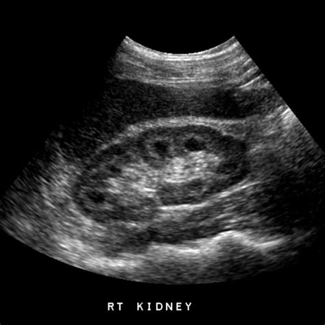 nephrocalcinosis on ultrasound - Google Search | Ultrasound sonography, Ultrasound, Medullary ...