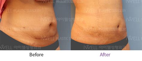 Tummy Tucks in Korea : Recovery, Scars, and Costs - JIVAKA.CARE