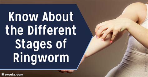 The Different Stages of Ringworm