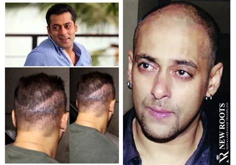 Salman Khan Hair Transplant Journey 2024 - Full Details