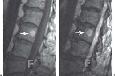 Tumors of the Spine | Radiology Key