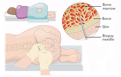 Bone Biopsy Recovery Time - mapageprek