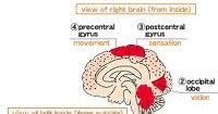 onceuponaman: Dysarthria | Understanding and definition of the Dysarthria | Causes of the Dysarthria