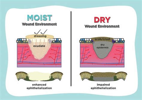 Lessons From Epithelialization: The Reason Behind Moist Wound Environment | Wound healing ...