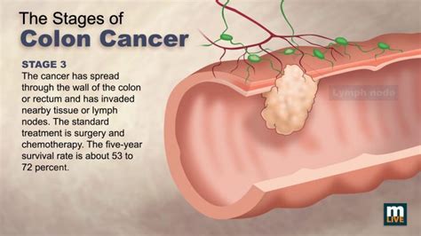 stage 4 colon cancer - Tech News Era