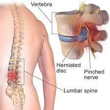 HNP Lumbal Itu Apa dan Terapi HNP Lumbal Terkini - RSU Bunda Jakarta