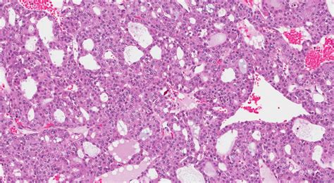 Acinic cell carcinoma of the salivary glands | Ottawa Atlas of Pathology