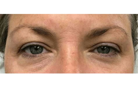 Before and After Nonsurgical Skin Tightening Photos