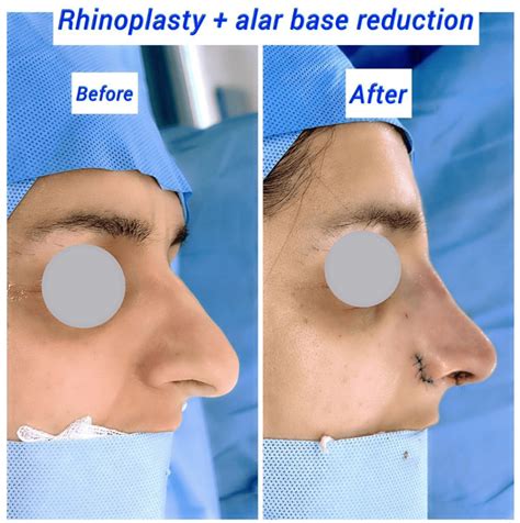 How Long is Alar Base Reduction Recovery? - Harley Clinic