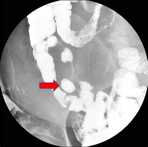 Meckel diverticulum | Radiology Case | Radiopaedia.org | Radiology ...