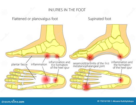 Supinated Foot, Arch Deformation, Bottom And Back View . Foot Weight ...