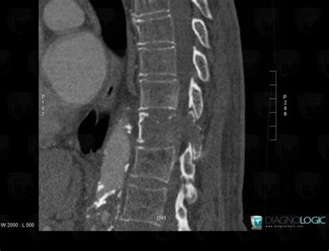 Radiology case : Malignant fibrous histiocytoma (CT ,MRI) - Diagnologic