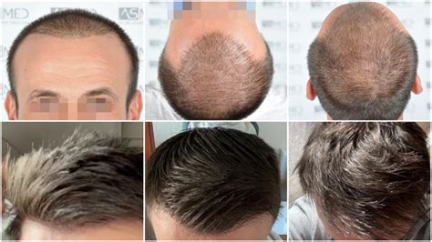 Norwood 6 Hair Transplantation Results | Asmed Hair Transplant