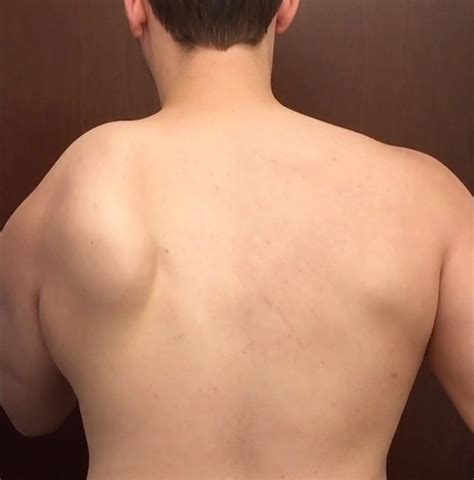 Serratus Anterior Weakness: One of Many Reasons for Shoulder Blade Winging - Shoulder & Elbow