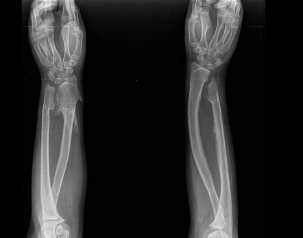 Hereditary multiple exostoses | Radiology Case | Radiopaedia.org