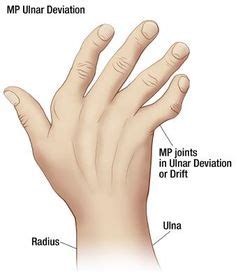 13 Health Conditions | Oh My Arthritiis ideas in 2022 | arthritis, thumb arthritis, carpal tunnel