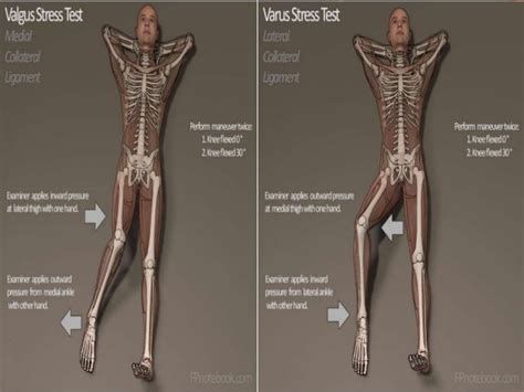 Soft tissue injury of the knee