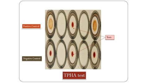 Treponema pallidum Haemagglutination (TPHA) Test: Introduction, Principl