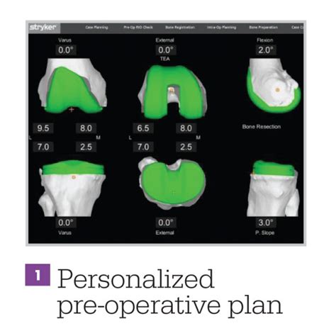 Mako Total Knee Replacement | Dr. Shahin S. Rad