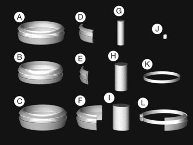 Techniques of Scleral Buckling | Ento Key