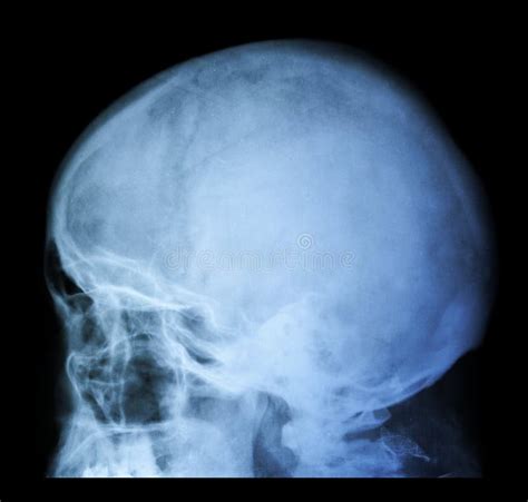 X Ray of Skull - Cranium Medical Analysis Stock Photo - Image of sciagraph, radiology: 278468258