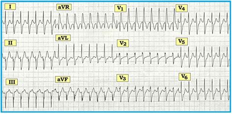 ECG Interpretation: ECG Interpretation Review #38 (WCT - SVT - VT - Fascicular - RBBB Aberration ...