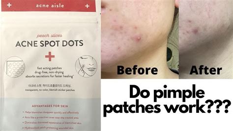 Do Pimple Patches Work? (I try the Peach Slices Acne Spot Dots from CVS) - YouTube