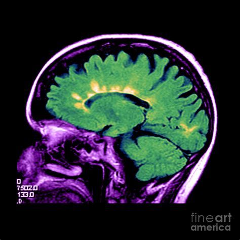 Mri Of Multiple Sclerosis Photograph by Medical Body Scans - Fine Art ...