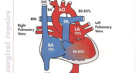 Heart defects, for everyone: Glenn Shunt, AKA Hemi-Fontan Procedure