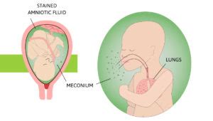 Today's Tip: Light Meconium-stained Fluid – Intellis