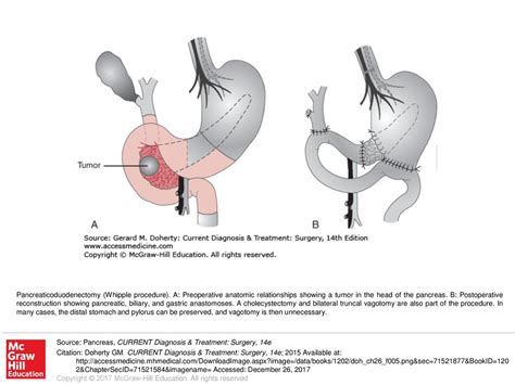 Pancreaticoduodenectomy (Whipple procedure) - ppt download