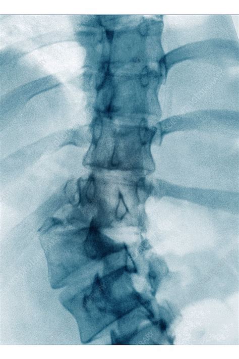 Rotational Dislocation of Scoliosis, X-ray - Stock Image - C030/6785 - Science Photo Library