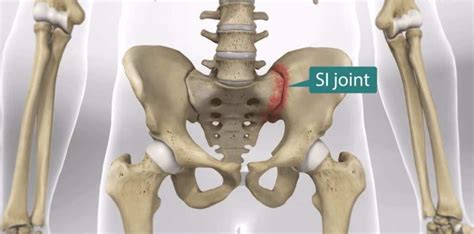 SI Joint Pain Symptoms & Treatment Options | Florida Surgery Consultants