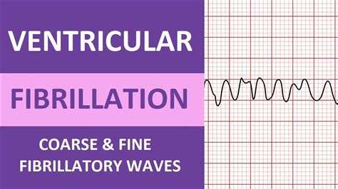 Ventricular Fibrillation (V-Fib) ECG Interpretation Nursing Heart ...