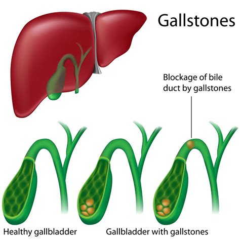 Gallstones | Symptoms and Treatment | Private Gastro London