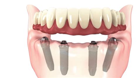 All on 4 Dental Implants - Sterling Dental Clinic - Dental Blogs India