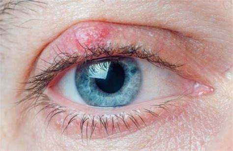 Chalazion Removal