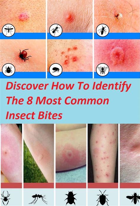 30 HD What Do Mosquito Bites Look Like On Humans - insectza