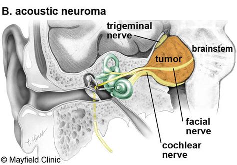 What is acoustic neuroma - Acoustic Neuroma Association