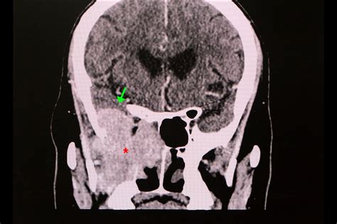 Skull Base Tumors 易- Dr. Aykut Unsal | Philadelphia